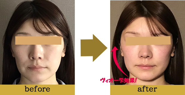 症例写真beforeafter