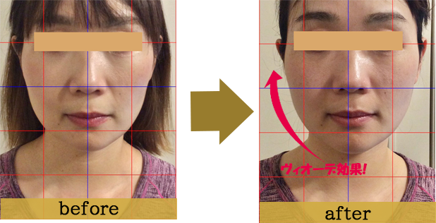 症例写真beforeafter