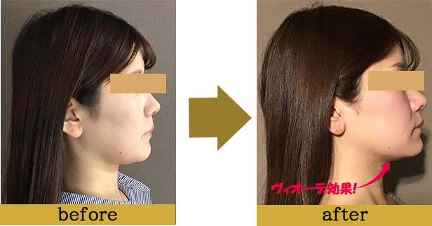 症例写真beforeafter