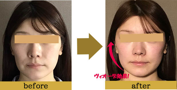 症例写真beforeafter