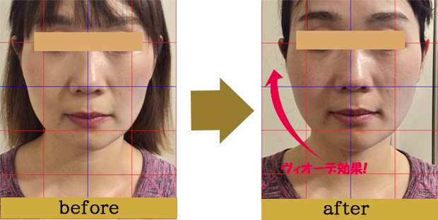 症例写真beforeafter